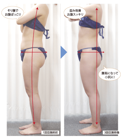 歪み改善お腹スッキリ